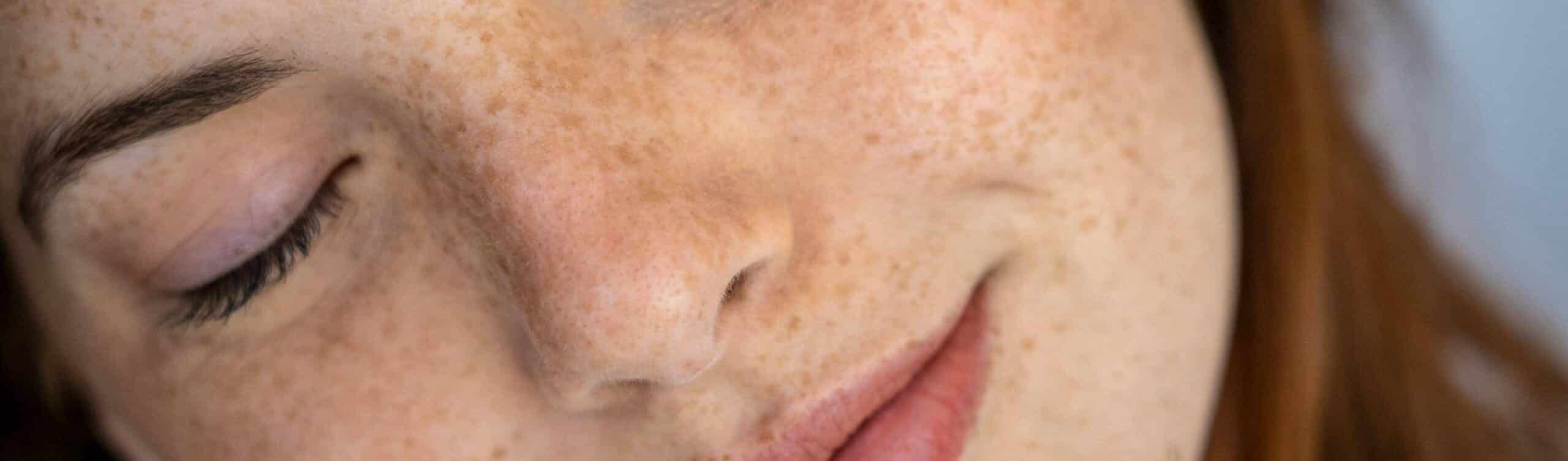 J'ai des taches brunes sur le visage : quelle solution en médecine esthétique ? | Maison Albanéa | Aubagne