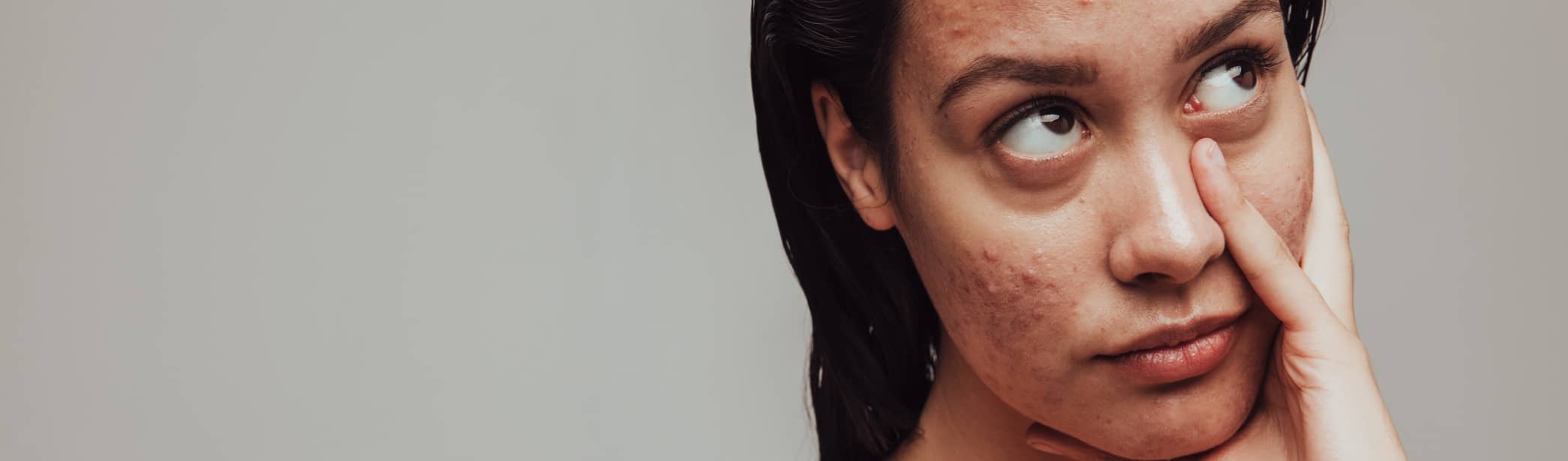 Quel est le traitement le plus efficace contre l'acné ? | Maison Albanéa | Aubagne