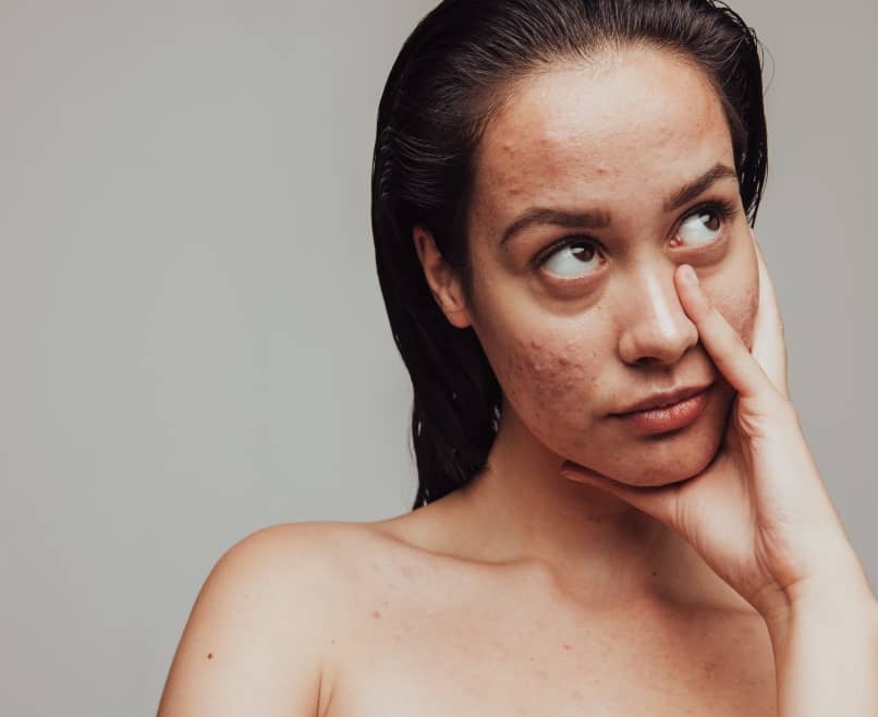 Quel est le traitement le plus efficace contre l'acné ? | Maison Albanéa | Aubagne