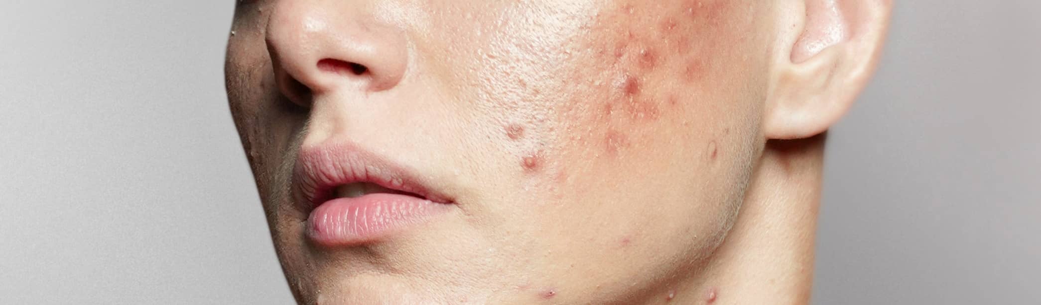 Comment supprimer les cicatrices liées à l'acné ? | Maison Albanéa | Aubagne