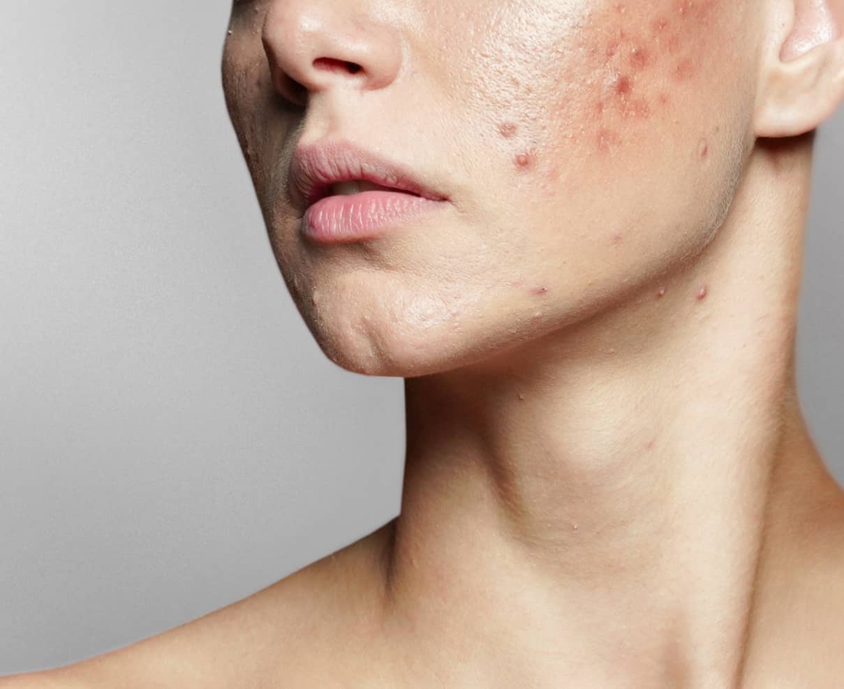 Comment supprimer les cicatrices liées à l'acné ? | Maison Albanéa ...