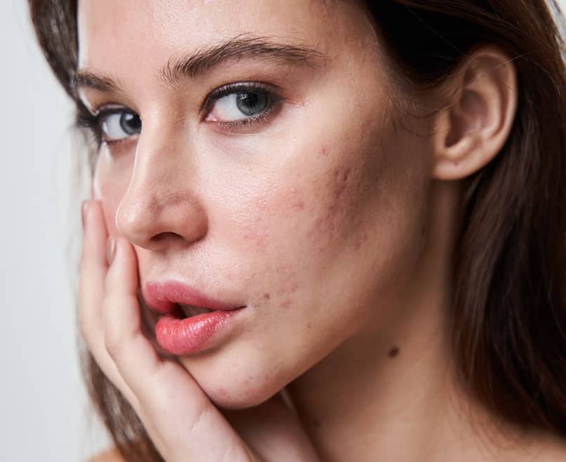 Qu'est-ce qui cause l'acné chez l'adulte ? | Maison Albanéa | Aubagne