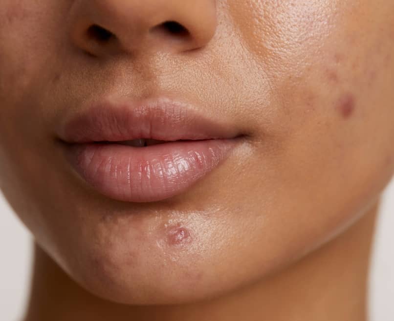 Quels sont les différents types d’acné ? | Maison Albanéa | Aubagne